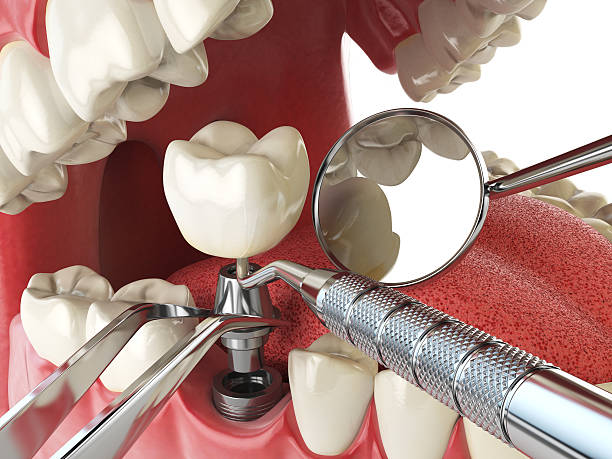 Best Emergency Wisdom Tooth Extraction in North Caldwell, NJ